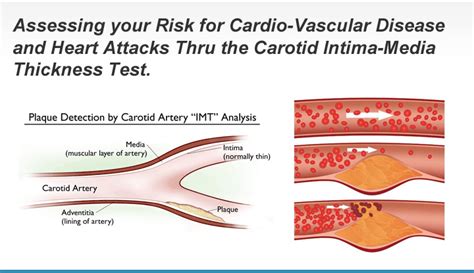 internal carotid thickness test